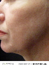 Chin - After