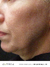Chin - Before