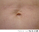 Tummy - After