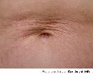 Tummy - Before